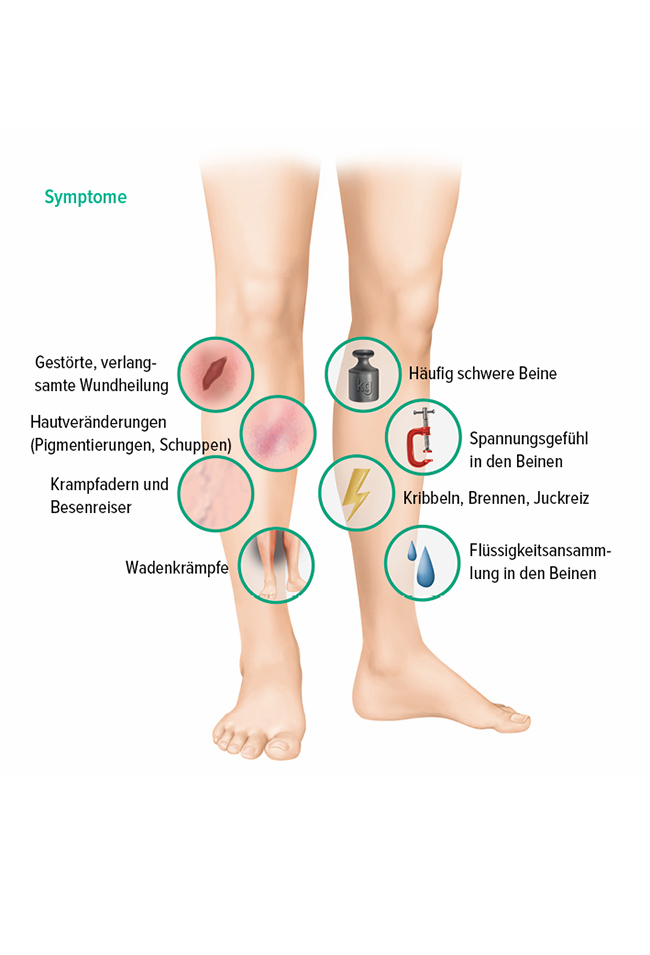 Symptome einer CVI Symptome einer CVI