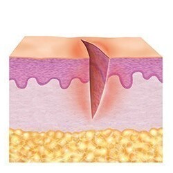 1. Cleaning phase (inflammation phase)