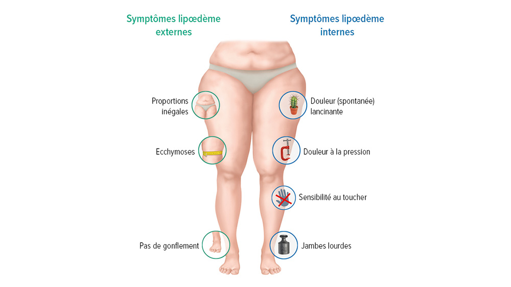 Les symptômes d'un lymphœdème Les symptômes d'un lymphœdème