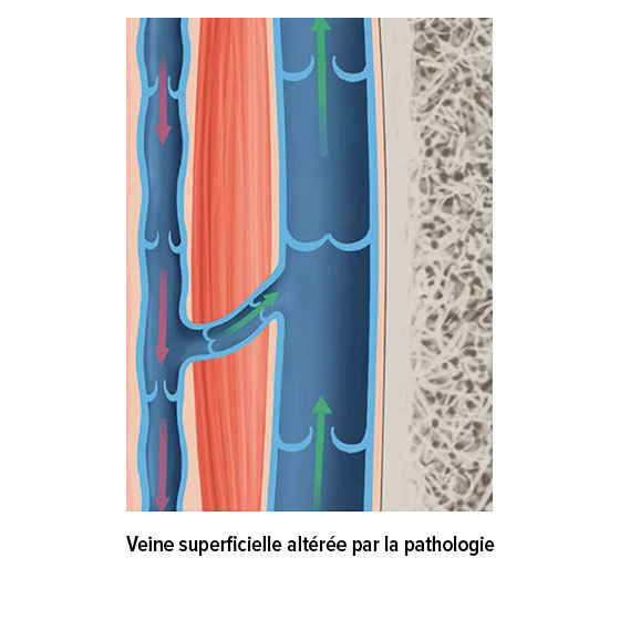 Veine superficielle pathologiquement altérée Veine superficielle pathologiquement altérée
