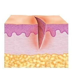 1. Reinigingsfase van de huid (ontstekingsfase)