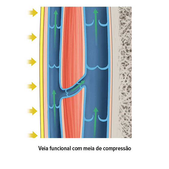 Veia funcional com meia de compressão Veia funcional com meia de compressão